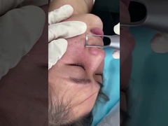 피부 침착 손상 문제 치료를 위한 1064nm 532nm 살론 피코초 레이저 기계